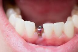 مراحل ایمپلنت دندان چگونه است؟ + قیمت در سال 1404