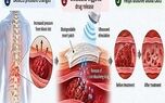 ساخت پچ هوشمند ۷۰ درصد در تجزیه لخته‌های خون پس از جراحی ستون فقرات