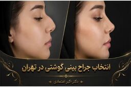 بینی گوشتی فقط مسئله اندازه نیست؛ پوست و غضروف چه نقشی در نتیجه جراحی دارند؟