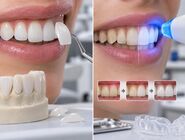 لمینت دندان یا بلیچینگ؟ تفاوت‌ها، کاربردها و انتخاب مناسب