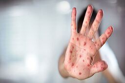  اعلام وضعیت اضطراری در نیویورک به دلیل شیوع سرخک