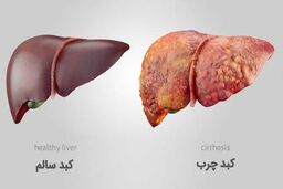 داروی جدید امیدها برای درمان سرطان کبد را افزایش داد